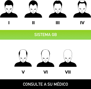 Etapas calvicie