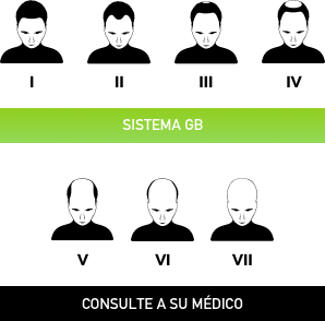 Etapas calvicie